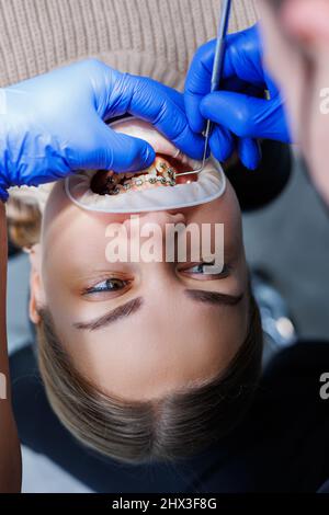 Les dents d'une femme avec des bretelles métalliques sont traitées à la clinique. Un orthodontiste utilise des instruments dentaires pour placer des bretelles sur les dents d'un patient. Sélection Banque D'Images