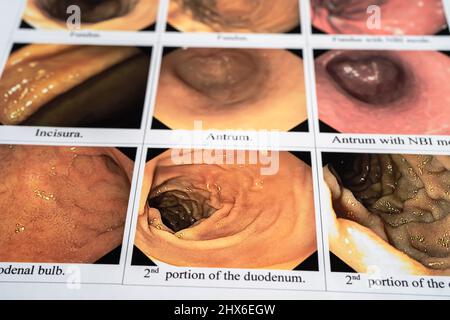 Blur oesophagogastroduodénoscopie, rapport d'examen de l'EGD d'une patiente asiatique souffrant de gastroscopie à l'hôpital. Banque D'Images