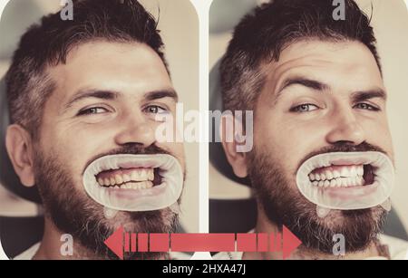 Dents jaune vs blanc, avant ou après le blanchiment. Homme avec un arrière-plan isolé touchant la bouche avec une expression douloureuse à cause de maux de dents ou dentaires Banque D'Images