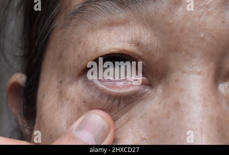 Peau pâle de femme asiatique âgée. Signe d'anémie. Pâleur à la paupière. Banque D'Images