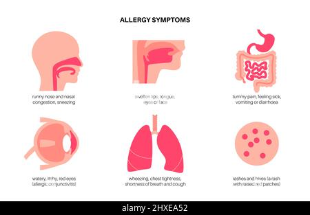 Symptômes d'allergie, illustration conceptuelle Banque D'Images