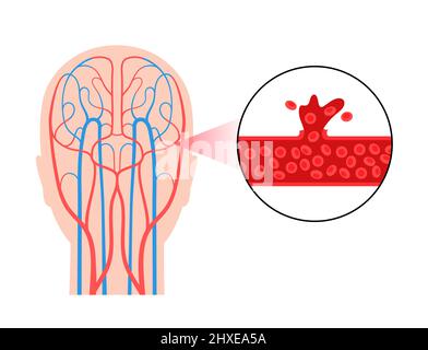 AVC hémorragique, illustration Banque D'Images
