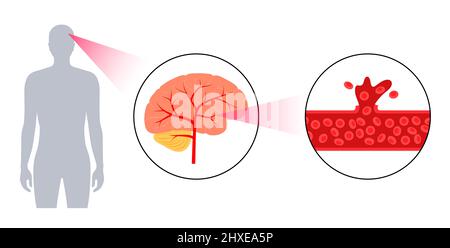 AVC hémorragique, illustration Banque D'Images