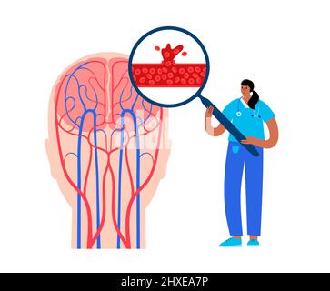 Recherche sur les accidents vasculaires cérébraux hémorragiques, illustration Banque D'Images