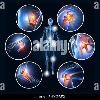 Un ensemble de six articulations douloureuses, illustration médicale 3D Banque D'Images