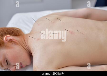 acuponcture thérapie sur le dos des épaules pour la femme cliente. femme subissant un traitement d'acupuncture avec une ligne d'aiguilles fines insérées dans le b mince Banque D'Images