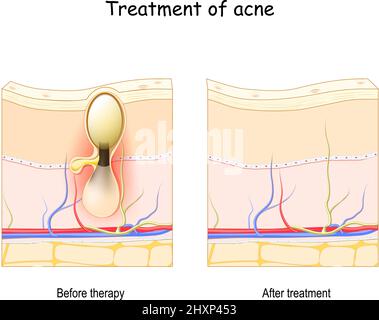 Traitement de l'acné. Avant et après la thérapie. Coupe transversale de la peau. Affiche vectorielle Illustration de Vecteur