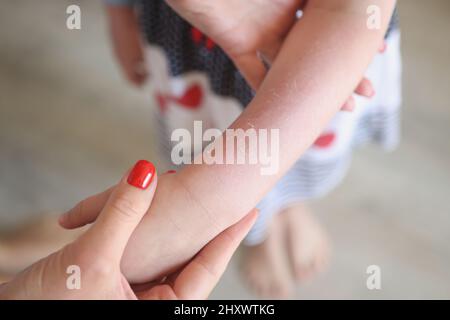 Femme examinant une éruption rouge sur les bras de l'enfant, irritation sur le corps des filles Banque D'Images