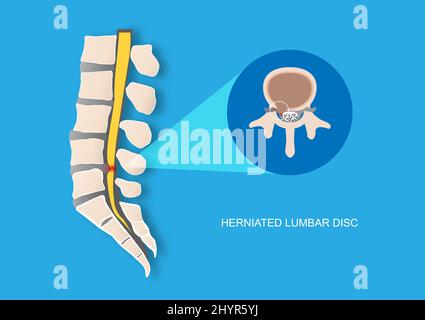 Illustration vectorielle de la douleur dorsale causée par un disque vertébral lombaire hernié. Protusion de disque intervertébral causant la compression des racines nerveuses. Illustration de Vecteur