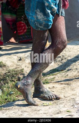 Satkhira, Bangladesh - 29 janvier 2017 : pattes d'un pêcheur avec des traces de boue sur tout le terrain, à côté de l'étang Banque D'Images