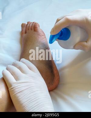 Le médecin met de la crème sur la jambe blessée. Banque D'Images
