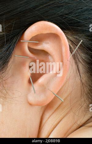 Acupuncture Banque D'Images