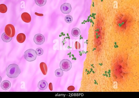 Les anticorps monoclonaux s'approchent de l'articulation inflammatoire dans la polyarthrite rhumatoïde - vue avant 3D illustration Banque D'Images
