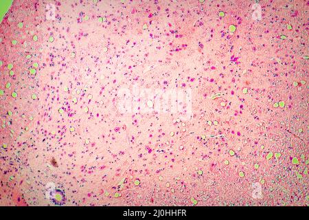 biopsie des coupes de tissus pour vérifier la présence d'une tumeur maligne. Vue au microscope Banque D'Images