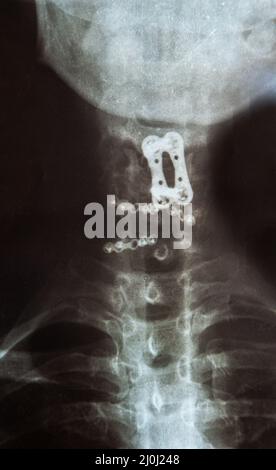 Image radiographique de la colonne vertébrale avec implant, positionnement des vis et fusion Banque D'Images