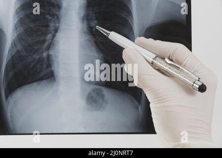 Radiographie avec stylo. Haute qualité et résolution magnifique concept de photo Banque D'Images