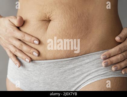 Femme gros plan avec des marques extensibles Banque D'Images