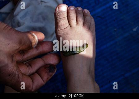 21 mars 2022, Srinagar, Jammu-et-Cachemire, Inde: Un praticien de Kashmiri donne le leech à un enfant sur un côté peu profond d'un lac à Srinagar, au Cachemire indien-administratif. À Nowruz, le premier jour du printemps et le début de l'année du calendrier perse, les professionnels de la santé traditionnels du Cachemire utilisent des sangsues pour traiter les patients souffrant de maladies de la peau, d'arthrite, de maux de tête chroniques et de sinusite. (Image de crédit : © Adil Abbas/ZUMA Press Wire) Banque D'Images