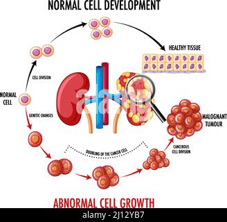 Schéma illustrant une cellule normale et une cellule cancéreuse Illustration de Vecteur