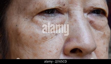 De petites taches brunes appelées taches d'âge sur le visage de la femme asiatique aînée. Ils sont également appelés taches de foie, lentilles séniles, ou taches de soleil. Vue en gros plan. Banque D'Images