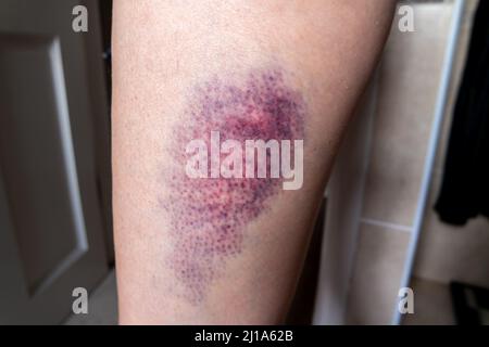 Terrible ecchymose sur la jambe supérieure d'une femme. Banque D'Images