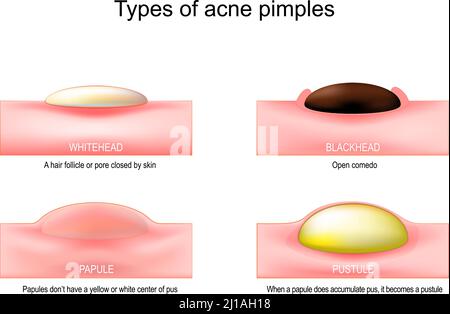 Types de boutons d'acné. Quand un papule accumule du pus, il devient un pustule. Les papules n'ont pas de centre jaune ou blanc de pus Illustration de Vecteur