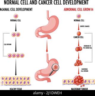 Schéma illustrant une cellule normale et une cellule cancéreuse Illustration de Vecteur