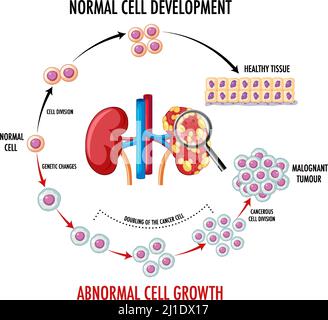 Schéma illustrant une cellule normale et une cellule cancéreuse Illustration de Vecteur
