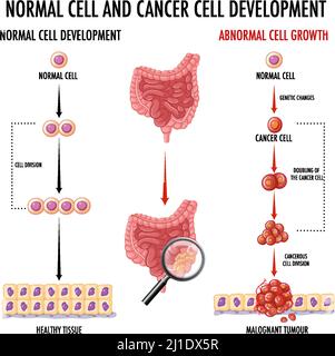 Schéma illustrant une cellule normale et une cellule cancéreuse Illustration de Vecteur