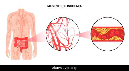 Ischémique mésentérique, illustration Banque D'Images