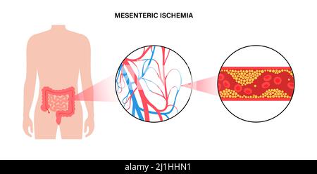 Ischémique mésentérique, illustration Banque D'Images
