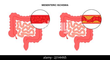 Ischémique mésentérique, illustration Banque D'Images