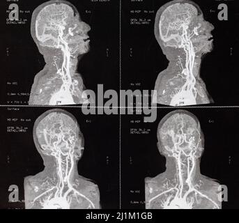 Photo en gros plan d'une IRM de contraste du crâne et des vaisseaux sanguins cérébraux d'une personne soupçonnée de sténose carotidienne Banque D'Images