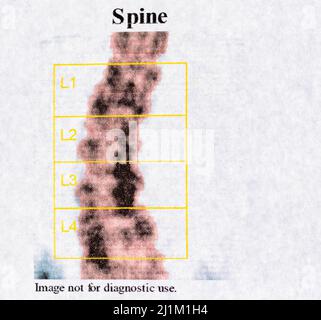 Photo en gros plan du test DEXA - ostéodensimétrie de la colonne vertébrale, qui mesure la densité osseuse à l'aide de rayons X, utilisé pour diagnostiquer l'ostéoporose Banque D'Images
