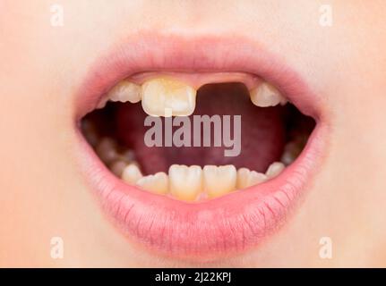 Mauvais dents enfant. Portrait garçon avec de mauvaises dents. L'enfant sourit et montre sa dent de surpeuplement. Gros plan sur les téths malsains de bébé. Patient enfant, bouche ouverte Banque D'Images