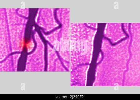 Sténose de l'artère iliaque Banque D'Images