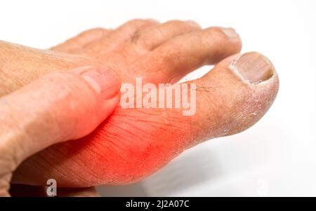 Inflammation de la base du gros orteil. Concept de douleur articulaire de pied, arthrite, trébuchement, hyperuricema ou goutte. Banque D'Images