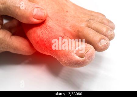 Inflammation de la base du gros orteil. Concept de douleur articulaire de pied, arthrite, trébuchement, hyperuricema ou goutte. Banque D'Images