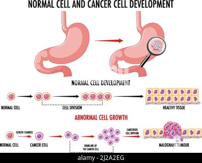 Schéma illustrant une cellule normale et une cellule cancéreuse Illustration de Vecteur