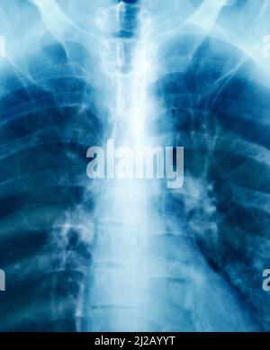 Examen radiographique du thorax humain d'une femme adulte en gros plan ou en gros plan. Diagnostic scientifique de la maladie. Banque D'Images