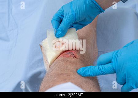 Infirmière soignante blessure fraîche sang sur l'os tibial de la jambe. Coller des points pour tenir la coupe. Banque D'Images