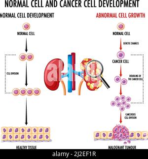 Schéma illustrant une cellule normale et une cellule cancéreuse Illustration de Vecteur