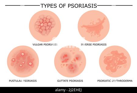 Différents types d'ensemble de vecteurs de psoriasis. Une partie de la peau des patients souffrant de dermatite, d'inflammation, d'éruption cutanée rouge et d'autres problèmes de peau. Illustration de dessin animé f Illustration de Vecteur