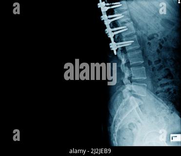 Vue latérale de l'os de la structure avec fixation interne pour empêcher la compression de l'os du rachis Banque D'Images