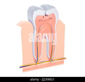 3d illustration de la vue anatomique d'une dent endommagée par des caries. Montrant l'intérieur, les veines, les artères et le nerf, la gencive et l'os. Banque D'Images