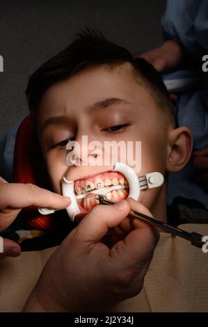 Gros plan de l'installation des bretelles sur les dents, alignement des dents avec les bretelles, enrouleur sur les lèvres, visite chez le dentiste. Banque D'Images