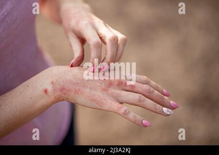 Dermatite d'eczéma sur les mains et les pieds. Taches rouges sur la peau. Peau sèche le concept dermatologie, traitement fongique. Femme se grattant la main. Banque D'Images