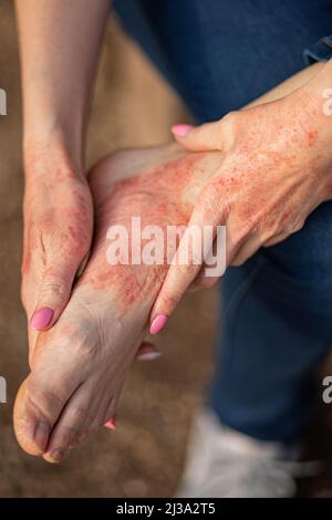 dermatite d'eczéma sur les mains et les pieds. taches rouges sur la peau. peau sèche. Banque D'Images