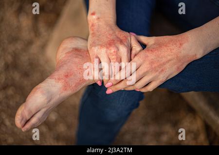 dermatite d'eczéma sur les mains et les pieds. taches rouges sur la peau. peau sèche. Banque D'Images