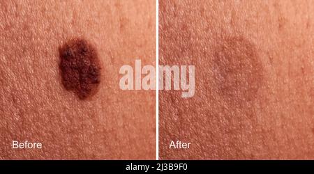 Photo avant et après l'enlèvement de la grosse mole sur la peau de la femme. Concept de suppression de mole Banque D'Images